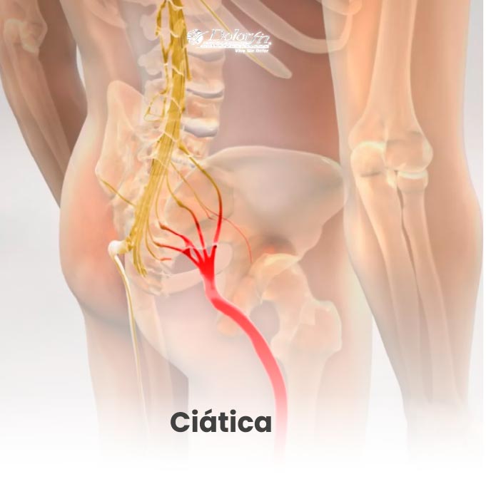 ciatica en tratamiento dolorfin quiropractico