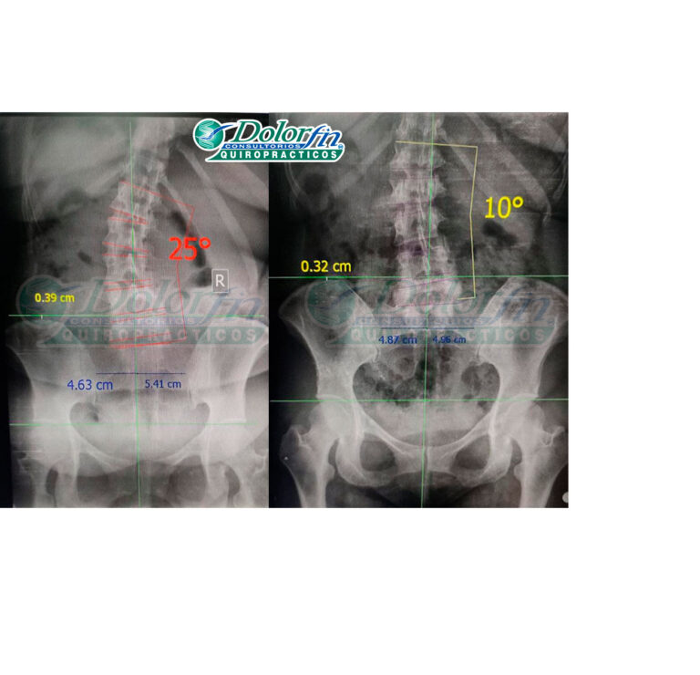 Dolorfin encuentro fortuna, lindavista: centro líder en quiropráctica y terapia física para el alivio de dolor en espalda y cuello.